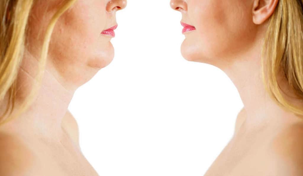 Double Chin treatment Minehead before and after results