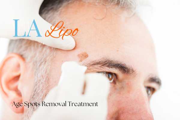 What Are the Most Effective Treatments for Age Spots Minehead?