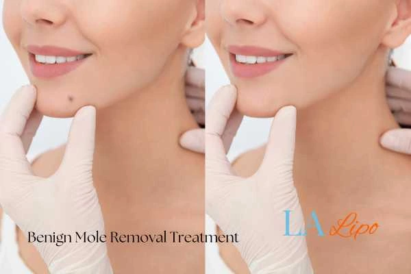 Before-and-after results following benign mole-removal treatment Minehead