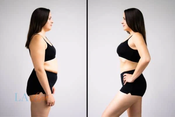image of woman before and after results of LA-EMS Body Sculpting Minehead to help treat Diastasis recti