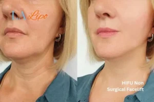 hi-fu for wrinkles Minehead before and after results
