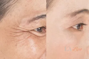 Before and after results of woman - HI-fu wrinkles reduction treatment Minehead