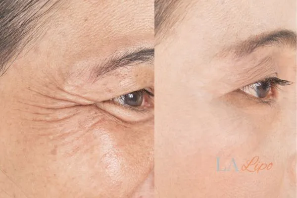 Before and after results of woman - HI-fu wrinkles reduction treatment Minehead