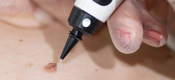 skin tag removal using cryopen Minehead