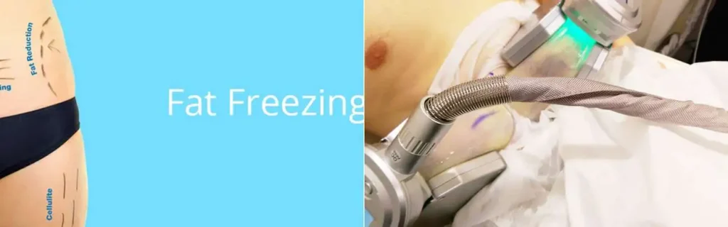 Fat freezing Minehead on multiple areas of the body