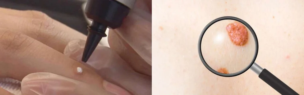 CryoPen practitioner Minehead assessing a benign mole before treatment