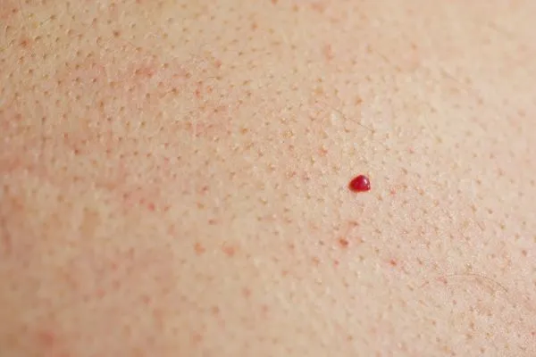 close up of a cherry angioma Minehead
