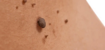 image of a skin tag Minehead