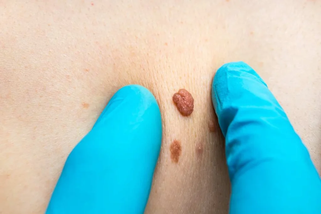Consultant examining a skin tag Minehead