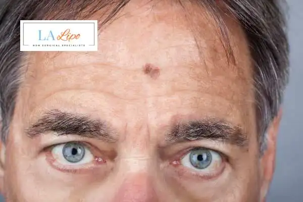 Solar Lentigo Removal Minehead image of man with mark on his forehead