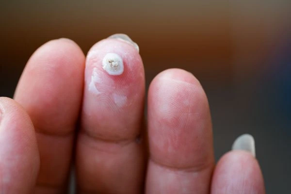 wart on person finger - cryotherapy to treat from LA LIPO Minehead