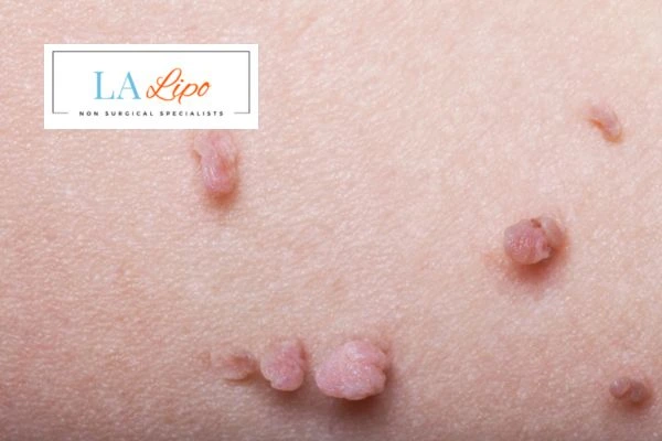 Does cryopen skin tag removal Minehead hurt? Find out now call our team today!