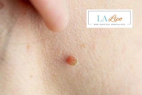 Book skin tag removal Minehead today speak to our team now!