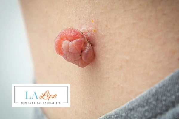 Interested in skin tag removal Minehead? Concerned about the pain? Find out more today!