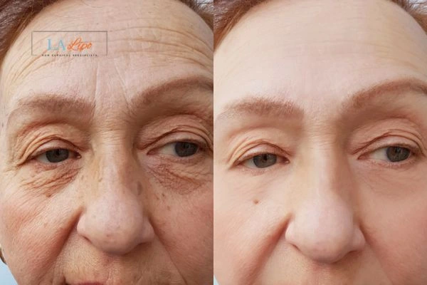 The powerful benefits of Morpheus8 Treatment Minehead - Call Our team today!