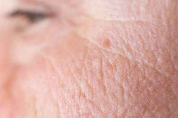close up picture of a woman's face showing an age spot Minehead