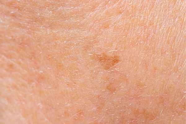 close up picture of age spots Minehead