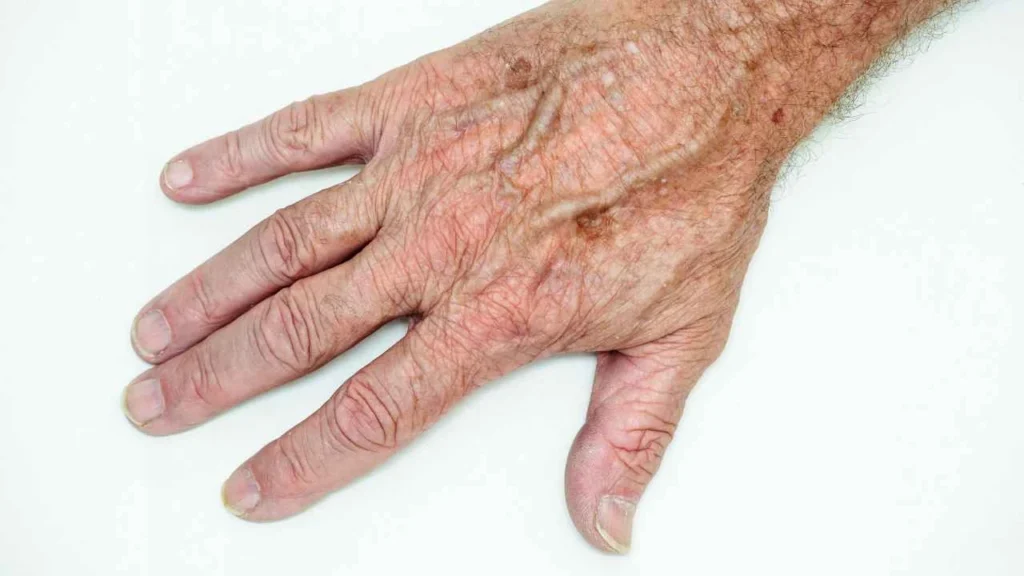 Male hand showing age spot Minehead